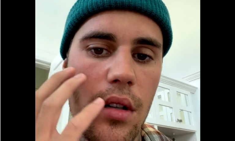 Justin Bieber Face Paralyzed After Wife’s Mini Stroke: Was it from COVID and Lack Of Vax?